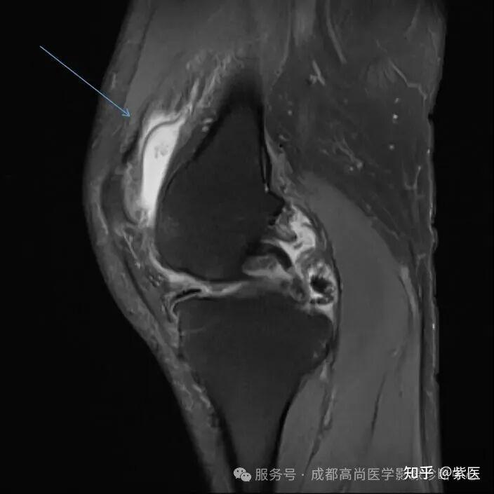 膝关节滑膜皱襞综合征(MPS)MR诊断 - 知乎