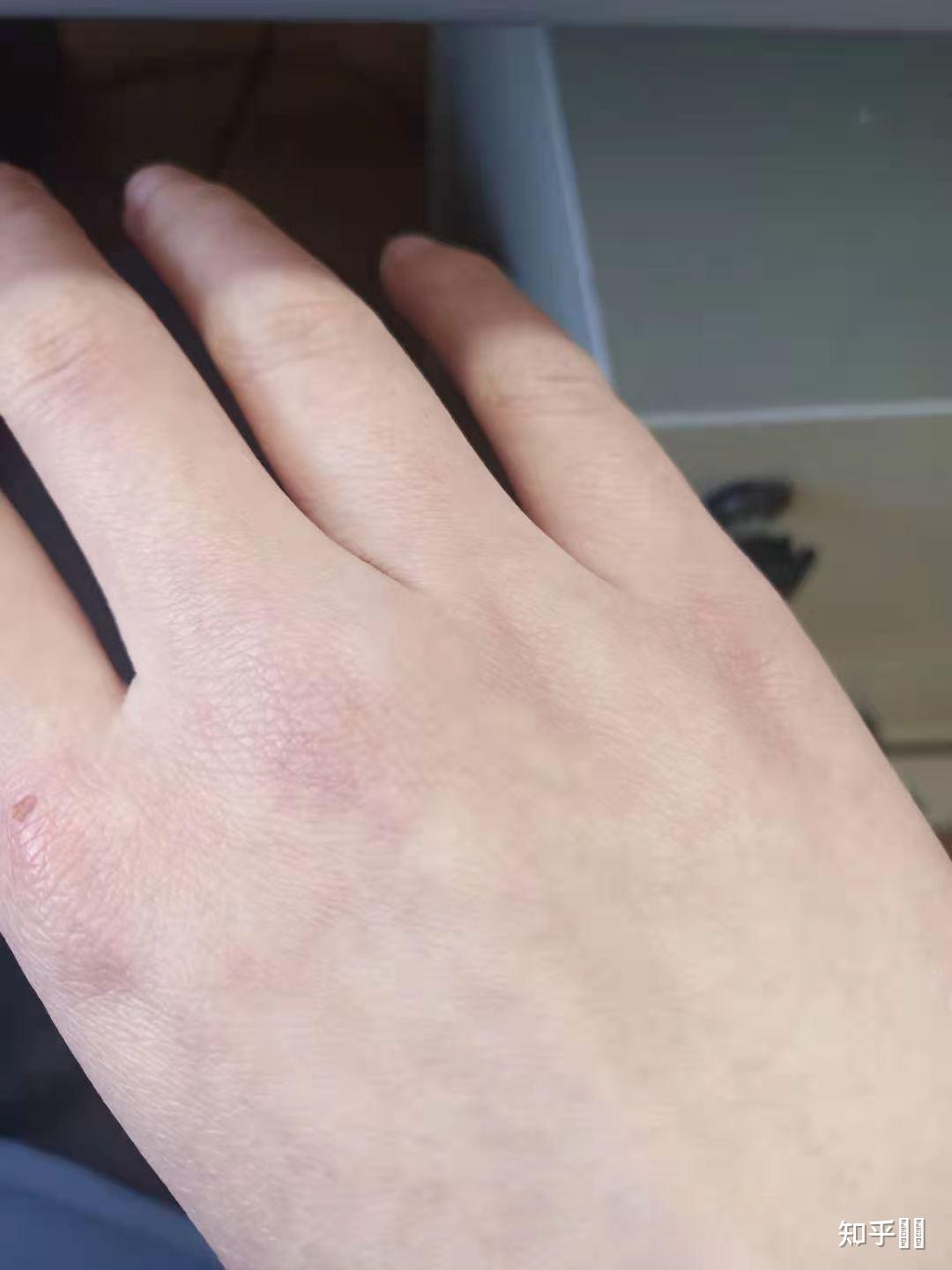 皮肤一冷就发紫浑身都是这样温度越高越白皙宝宝略痘印冻紫我的天恁们