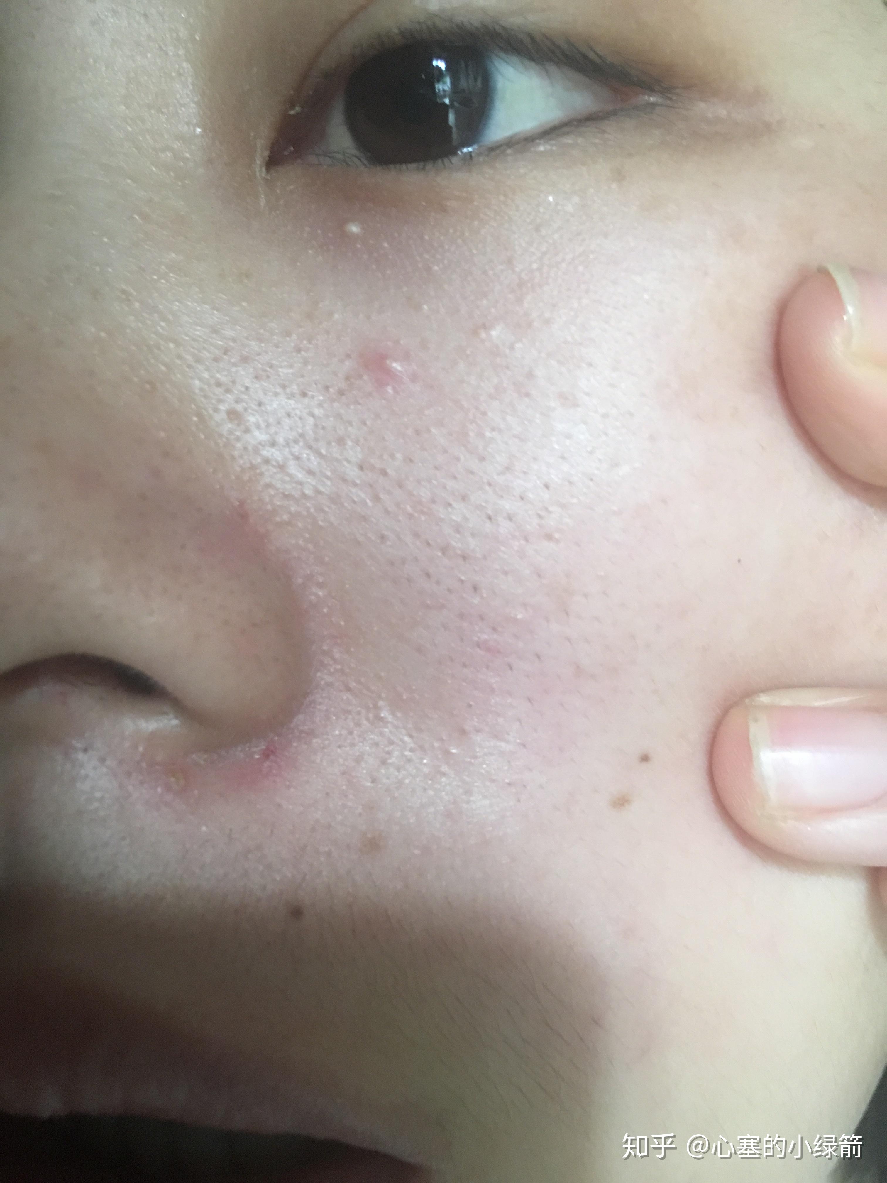 脸颊长毛怎么破? - 知乎