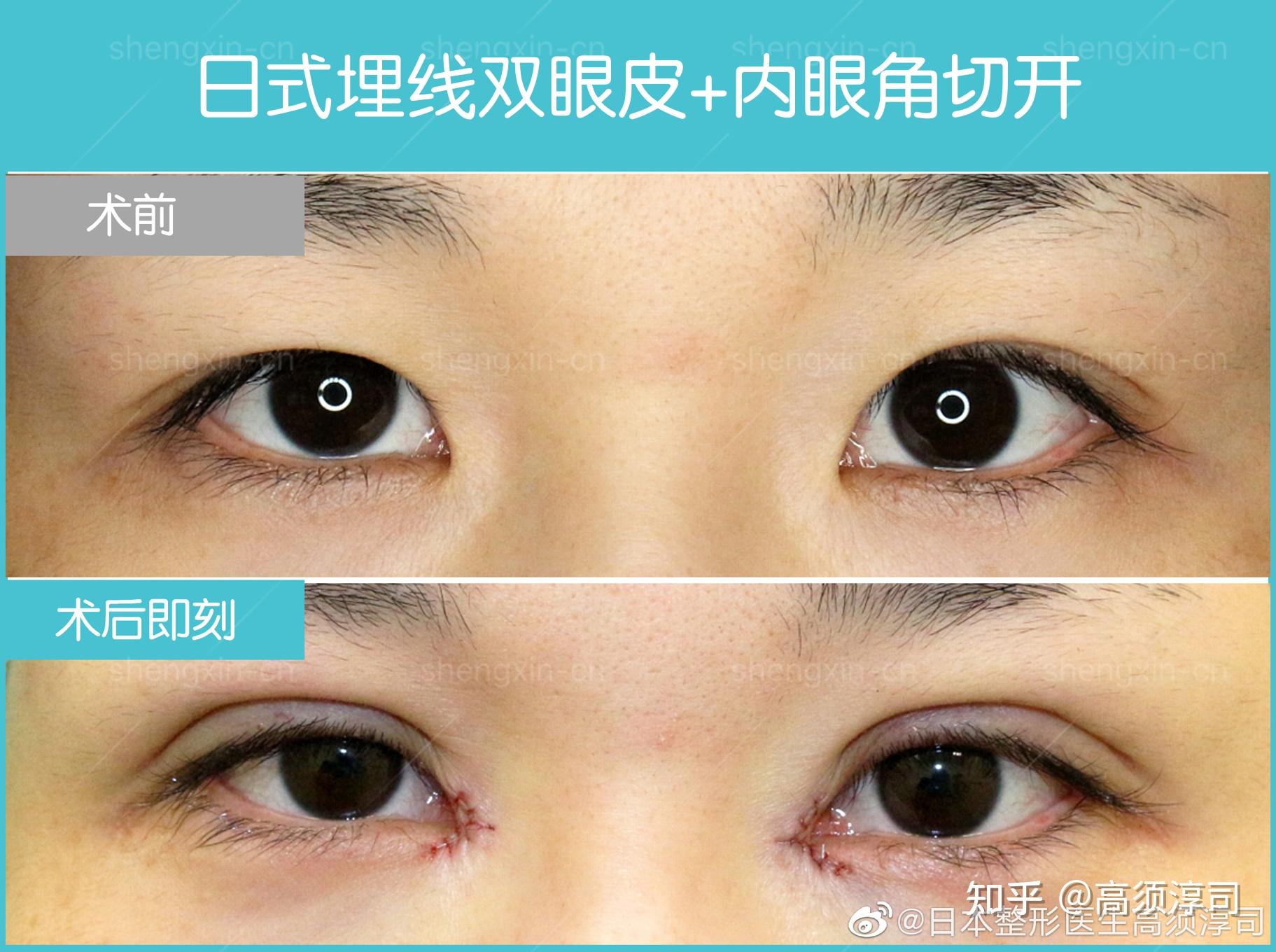 可以发一下你们开眼角的前后对比图吗