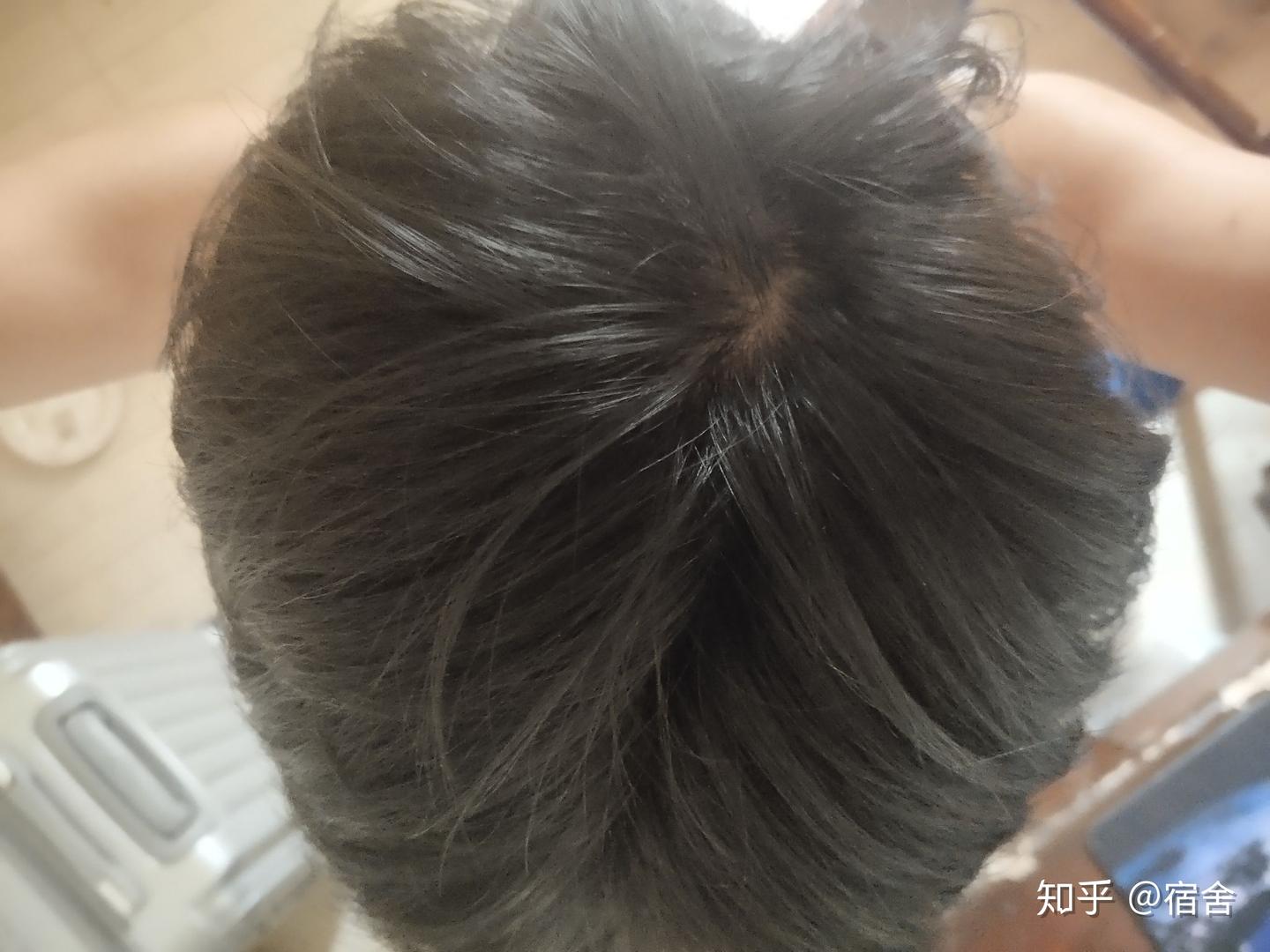 头上这样的发旋，正常不，？ - 知乎