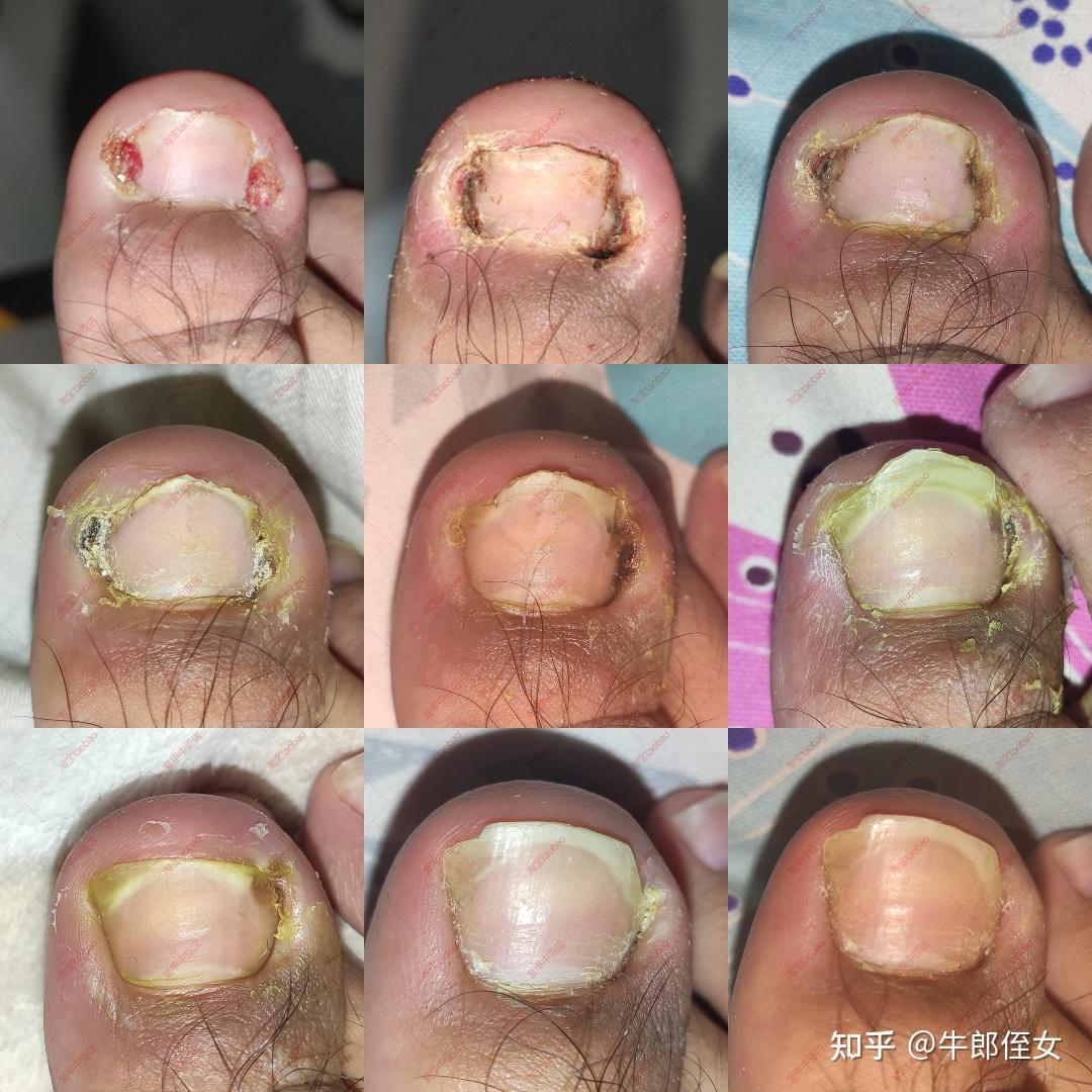 拔倒刺手指红肿怎么办?还有化脓的表现? - 知乎