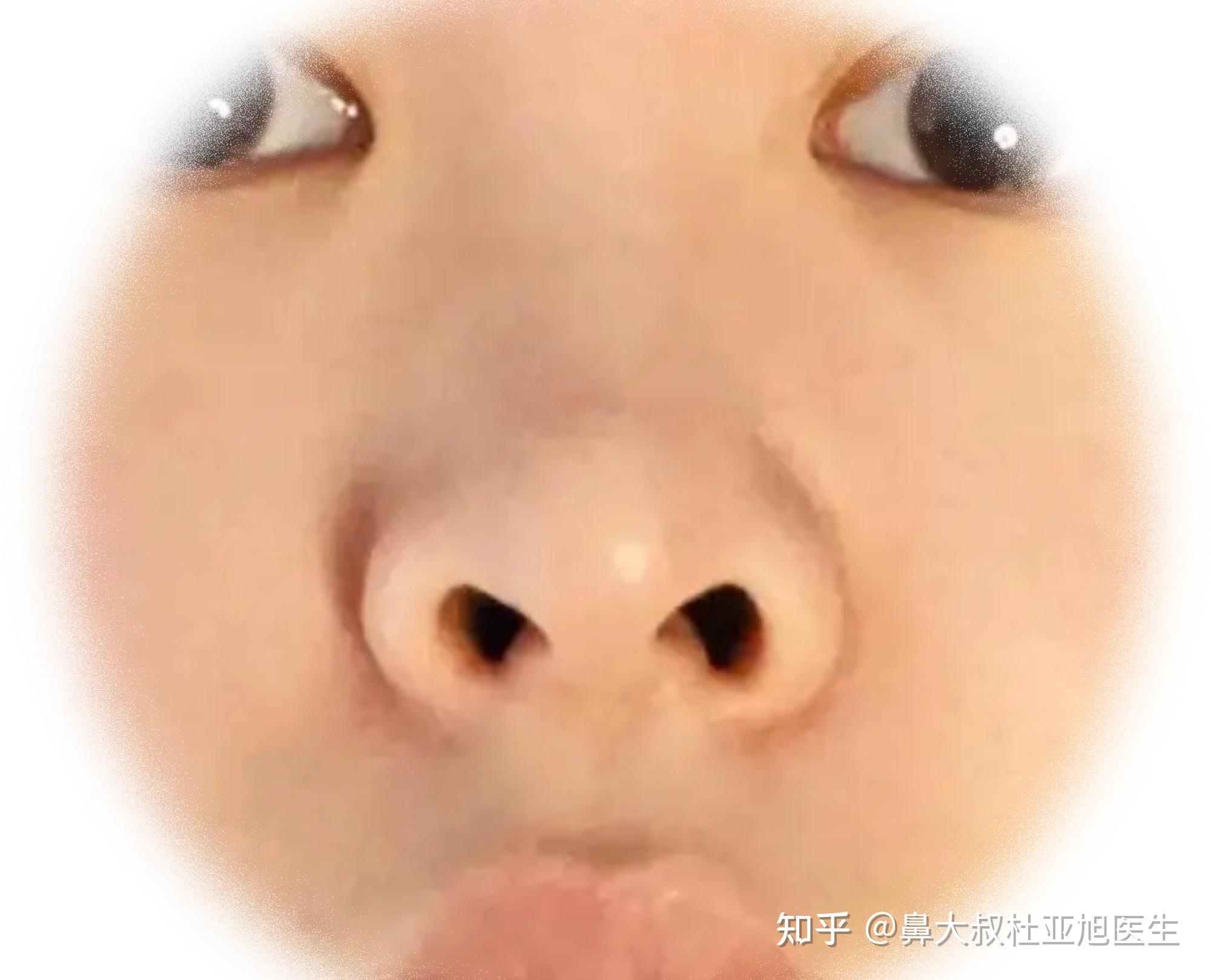 什么是朝天鼻?可纠正吗? - 知乎