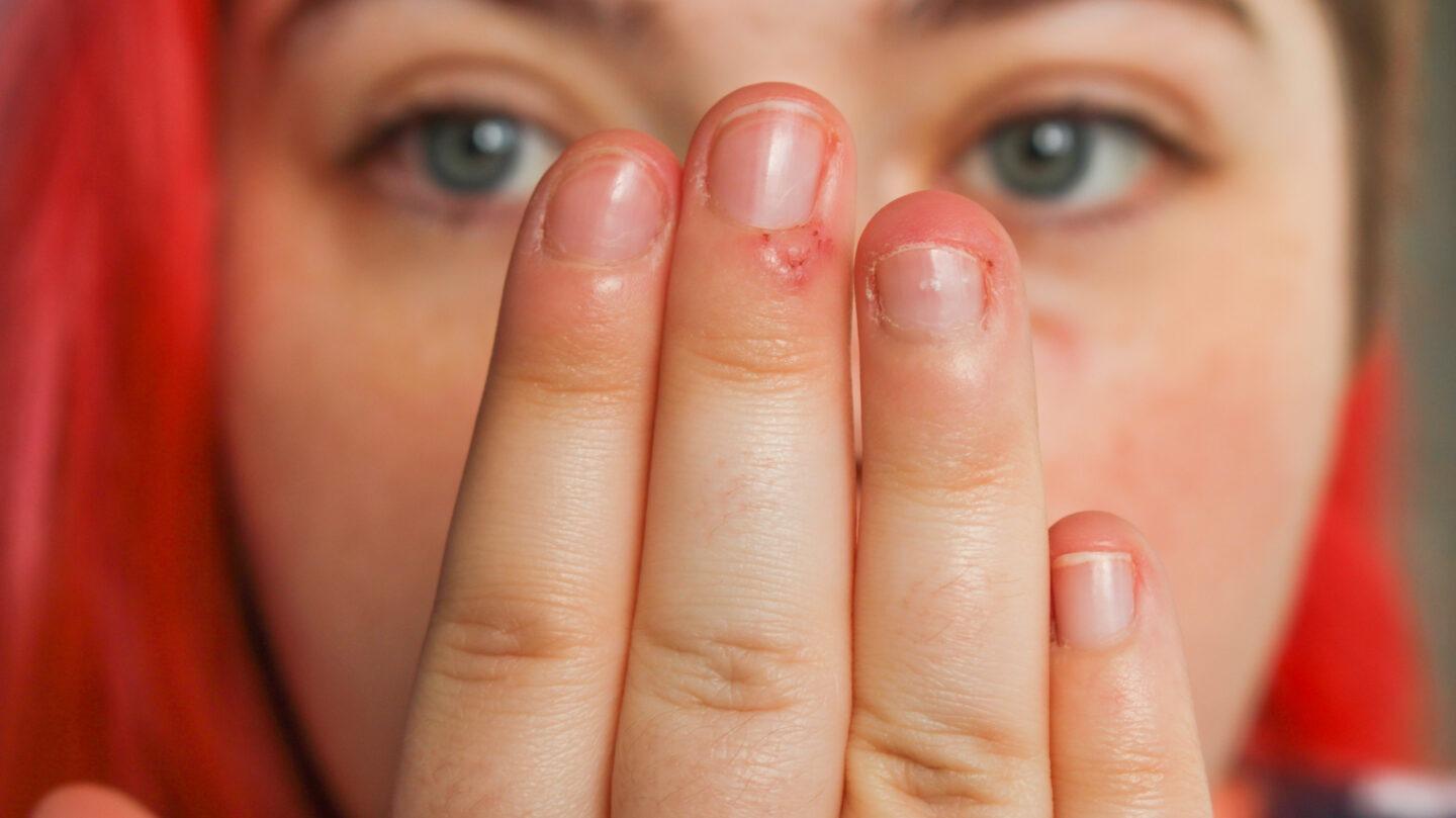 皮肤搔抓障碍(skin picking disorder, SPD) - 知乎