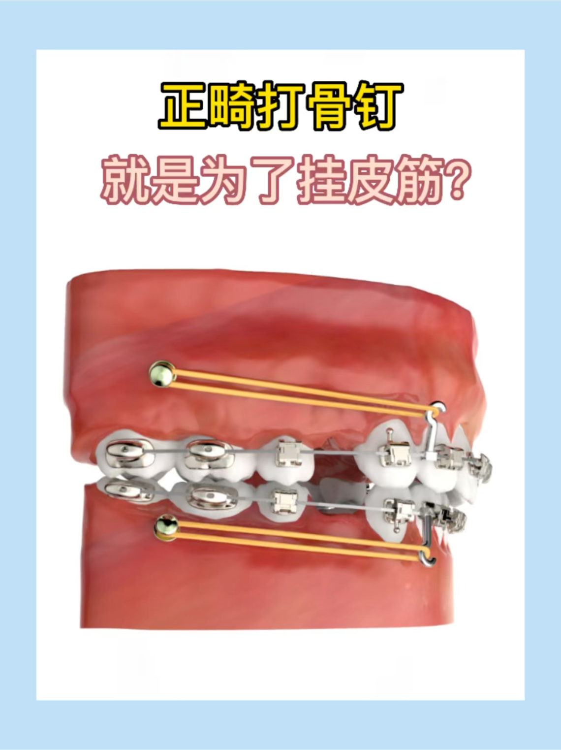 牙齿正畸打支抗钉(骨钉)的作用是什么?什么情况适合做? - 知乎