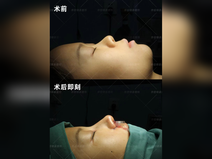 塌鼻梁 + 面中部凹陷太显土?河南姑娘初鼻改造,摆脱 “扁平脸”。 - 知乎