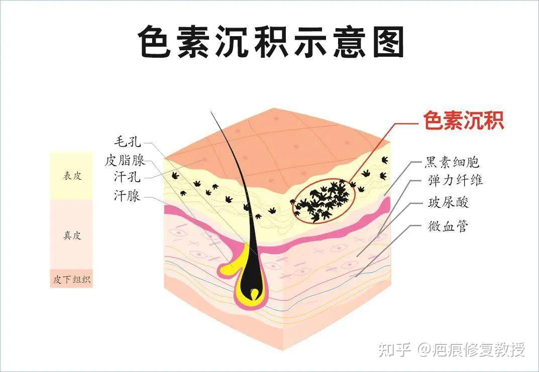 痘痘走了,留下痘印怎么办? - 知乎