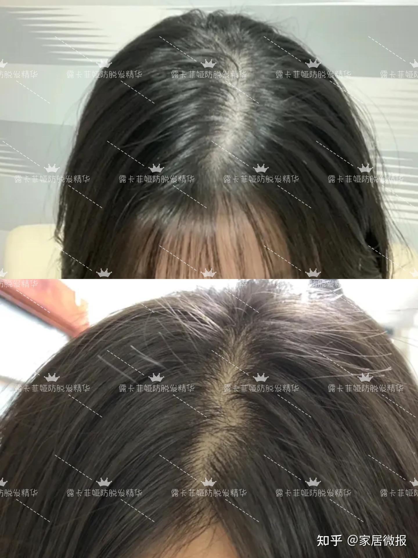 什么洗发水可以防脱发再生发？发缝宽，掉发严重的看过来！ - 知乎