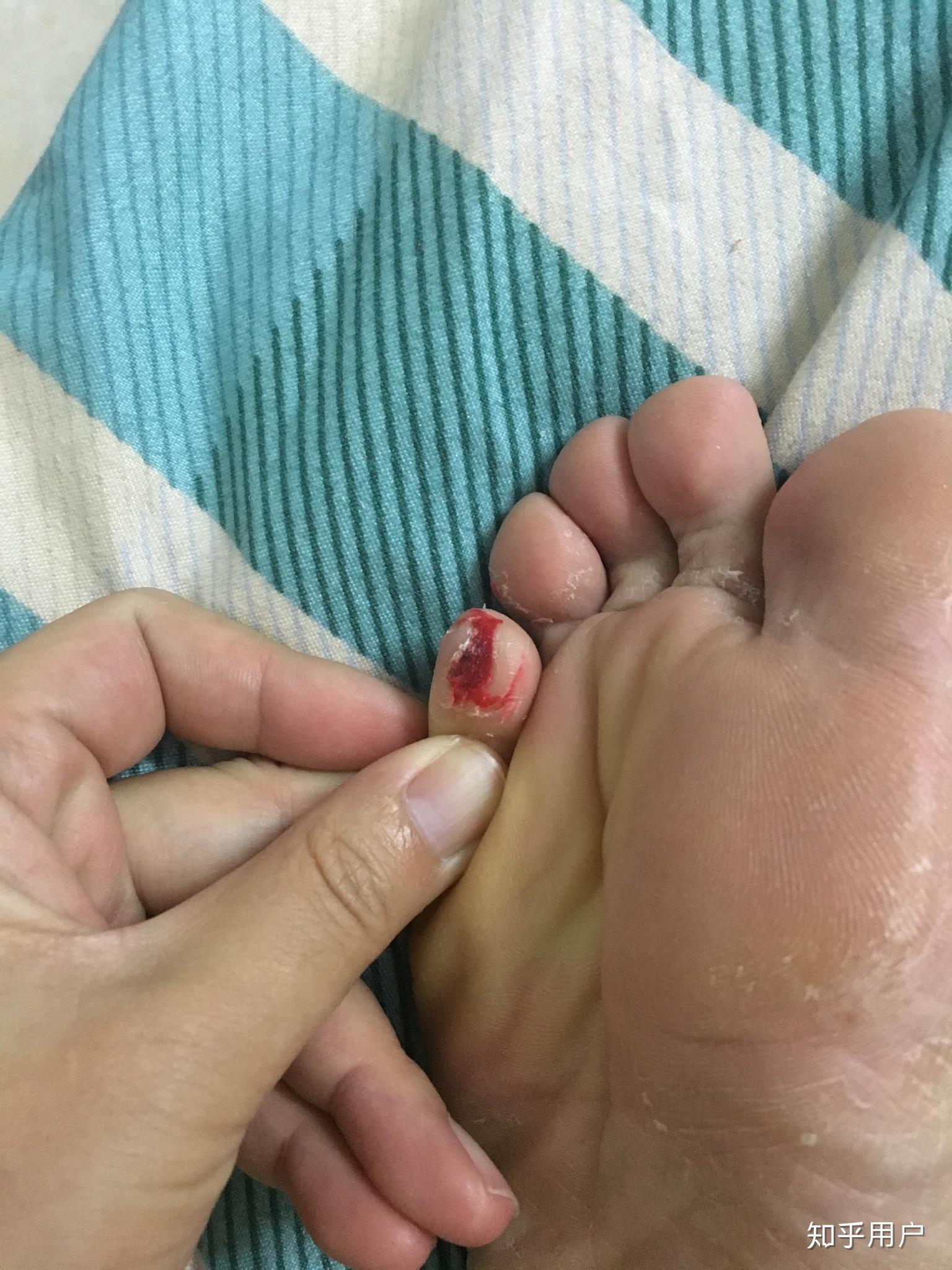 怎么治疗鸡眼? - 知乎