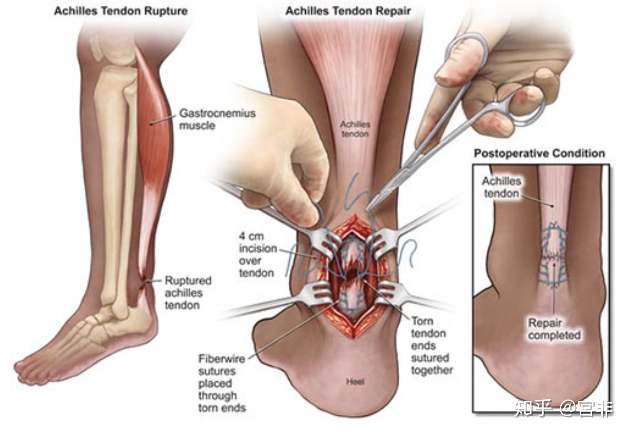 「跟腱断裂」的原因是什么,会造成什么后果,如何预防? - 知乎