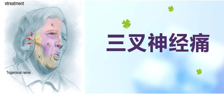 【在线答疑】70岁三叉神经痛患者如何选择治疗方法?能否彻底治痛? - 知乎