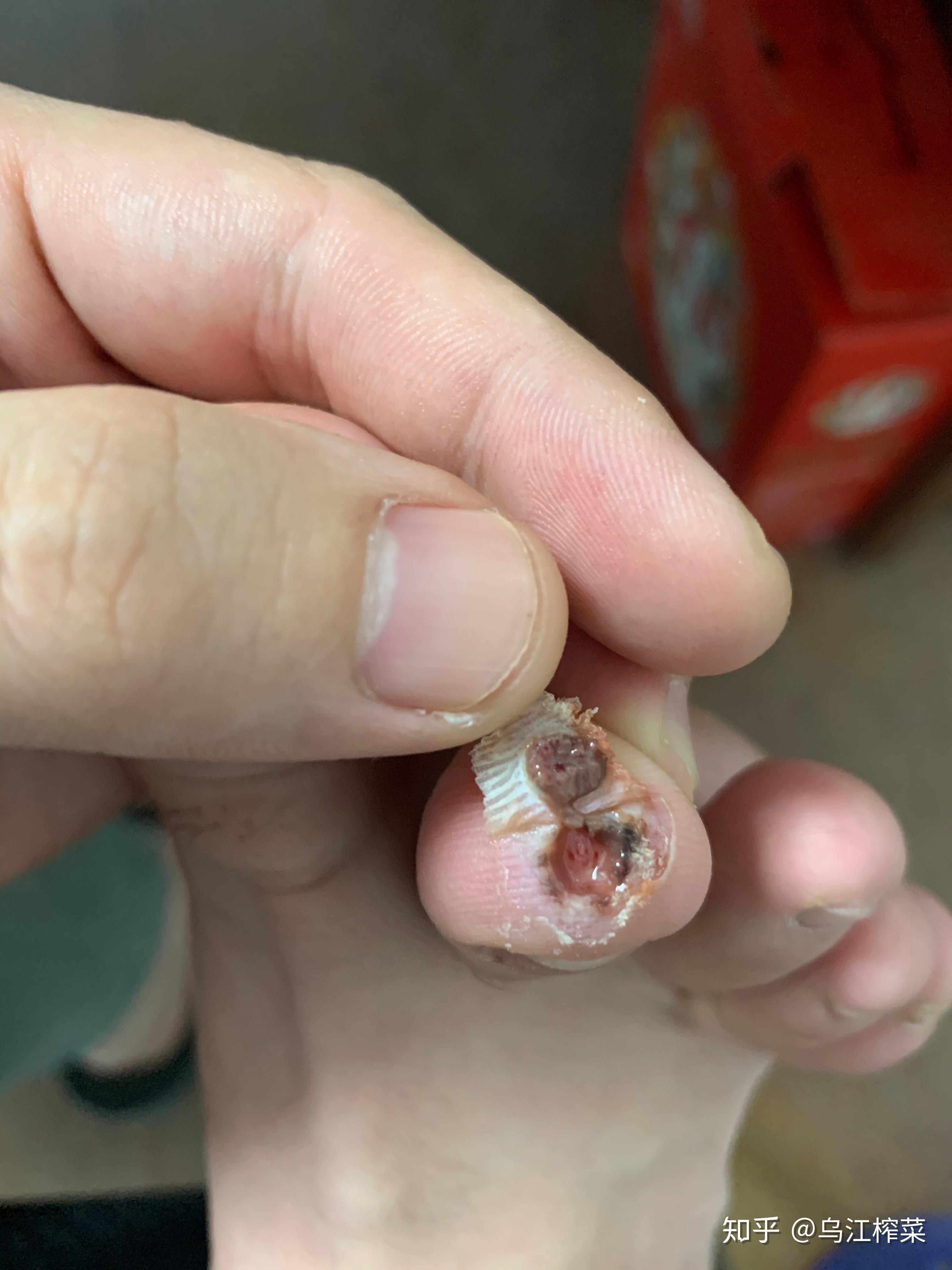 为什么会长鸡眼鸡眼怎么治疗