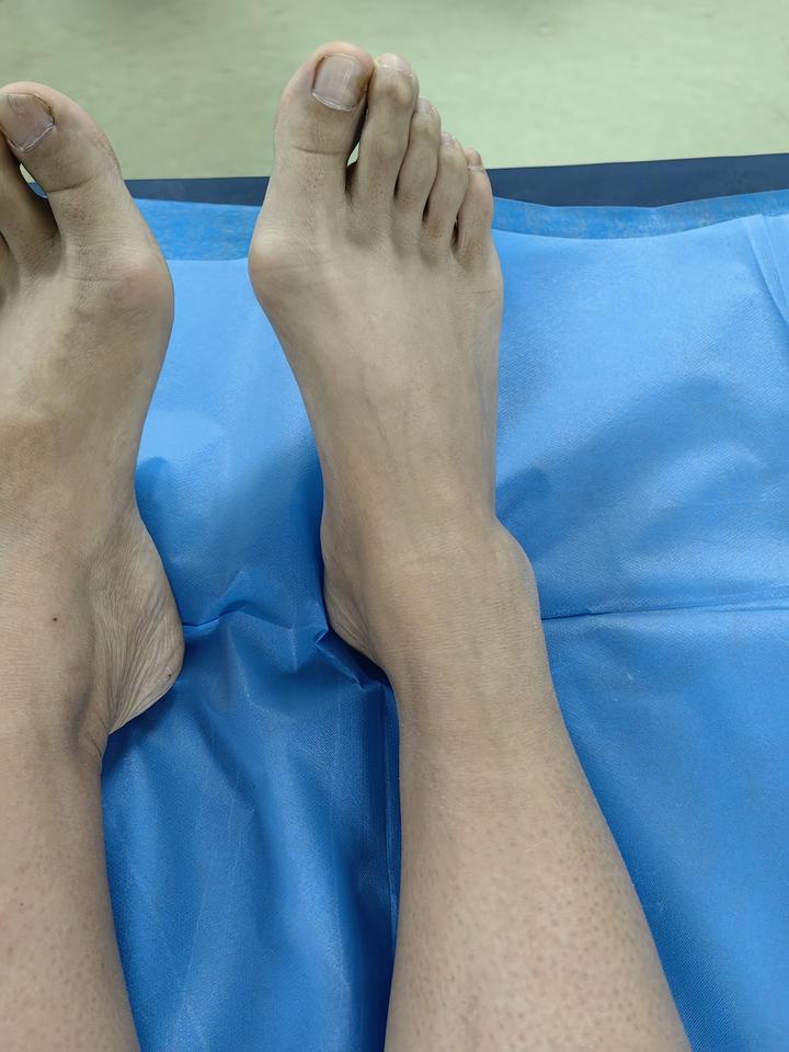 现在的脚丫子拇外翻拜拜啦