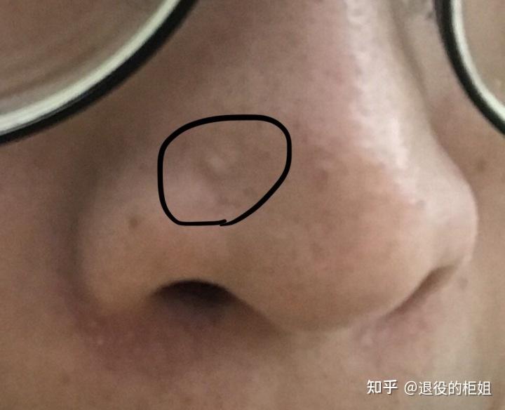 请问大家,我鼻子上的小凸起是啥呀?