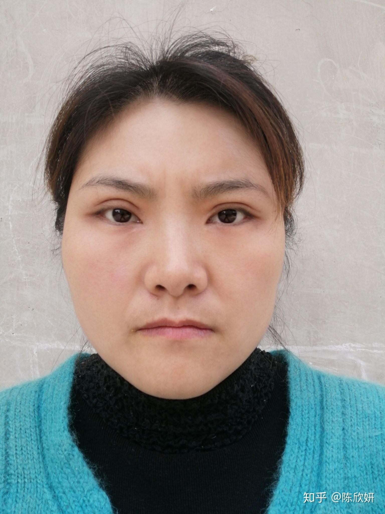 割双眼皮失败是什么样子的