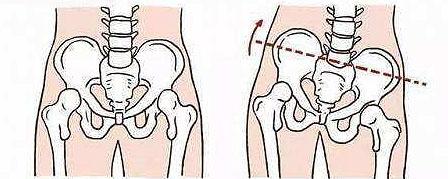 骨盆歪斜三阶段