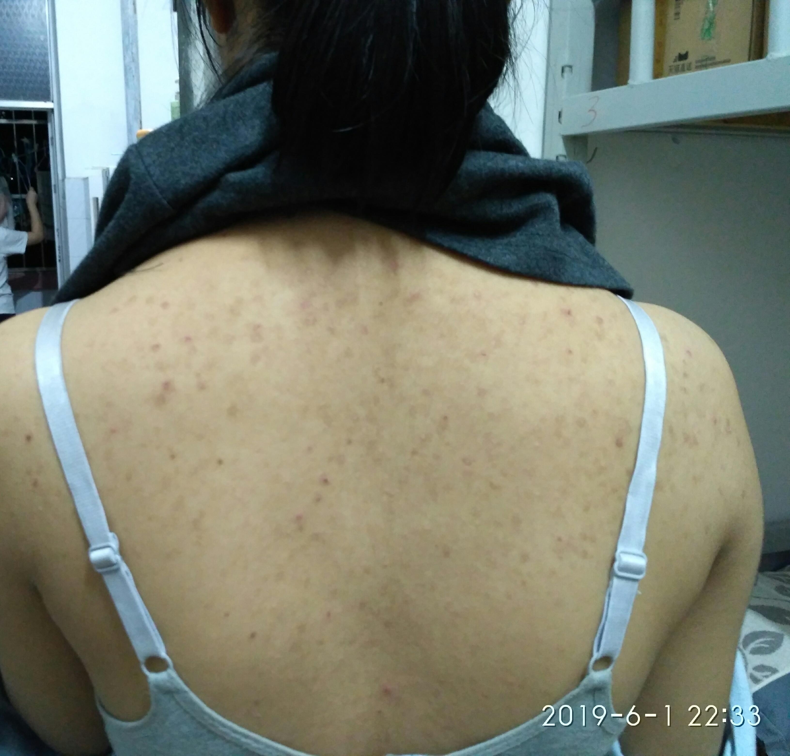 背后长痘并有红色痘印怎么消背部还可以用去角质膏吗