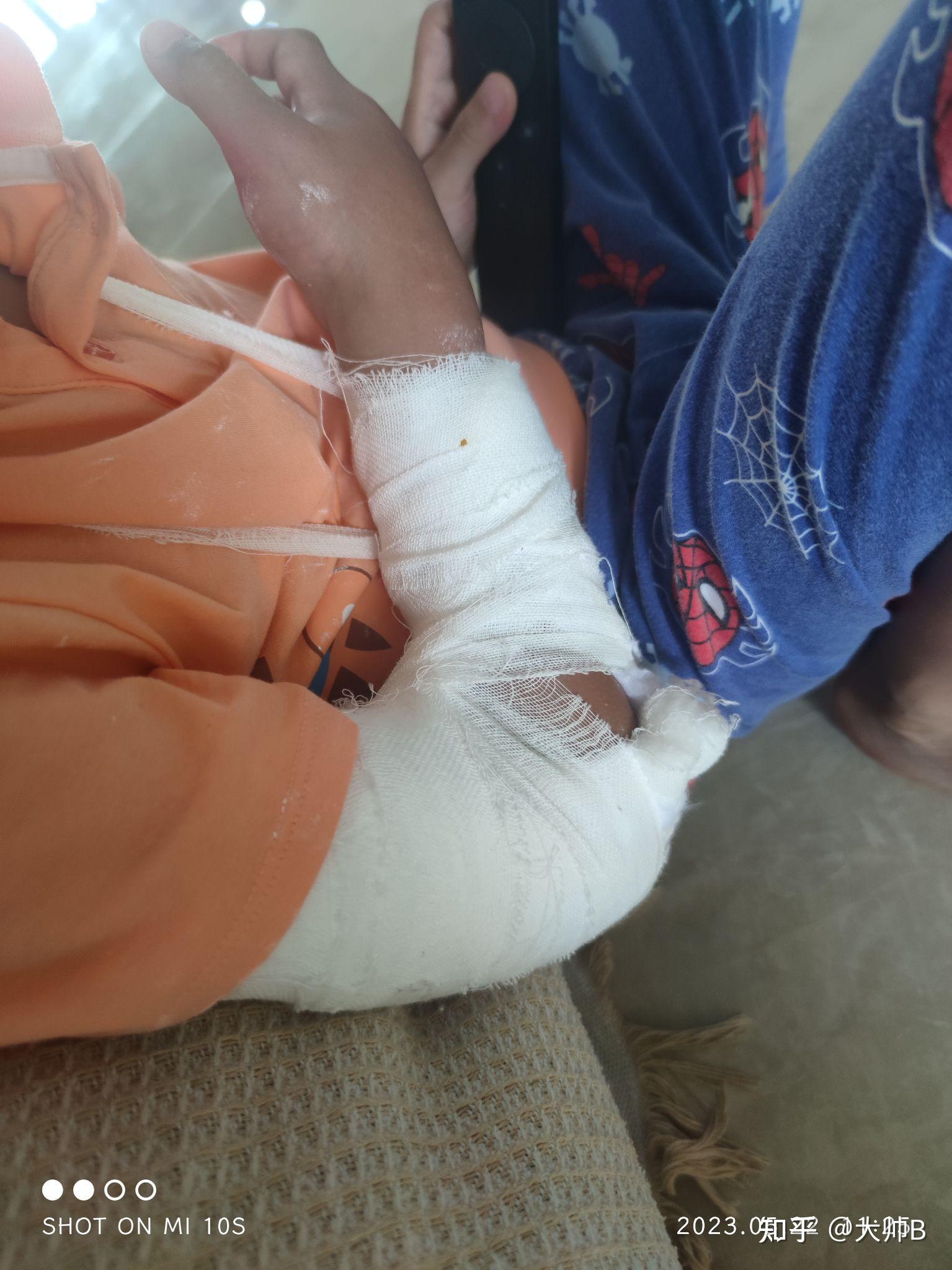 手臂右肱骨髁上骨折打石膏手指肿了正常嘛?如何减轻肿痛?