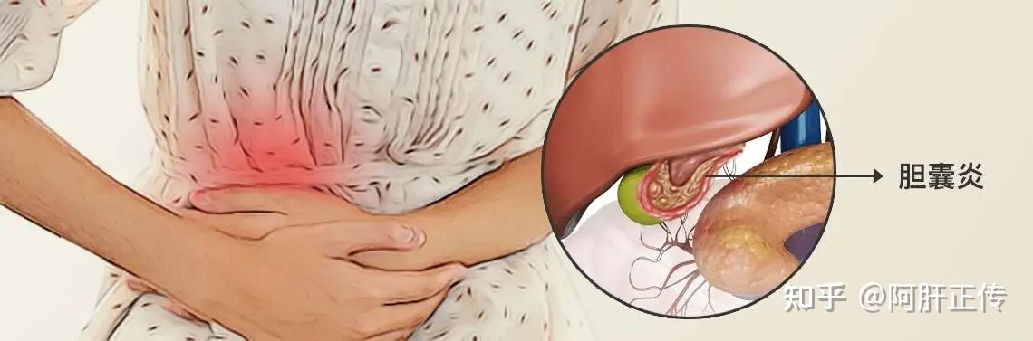 急性胆囊炎的症状、病因、保守治疗与微创手术 - 知乎