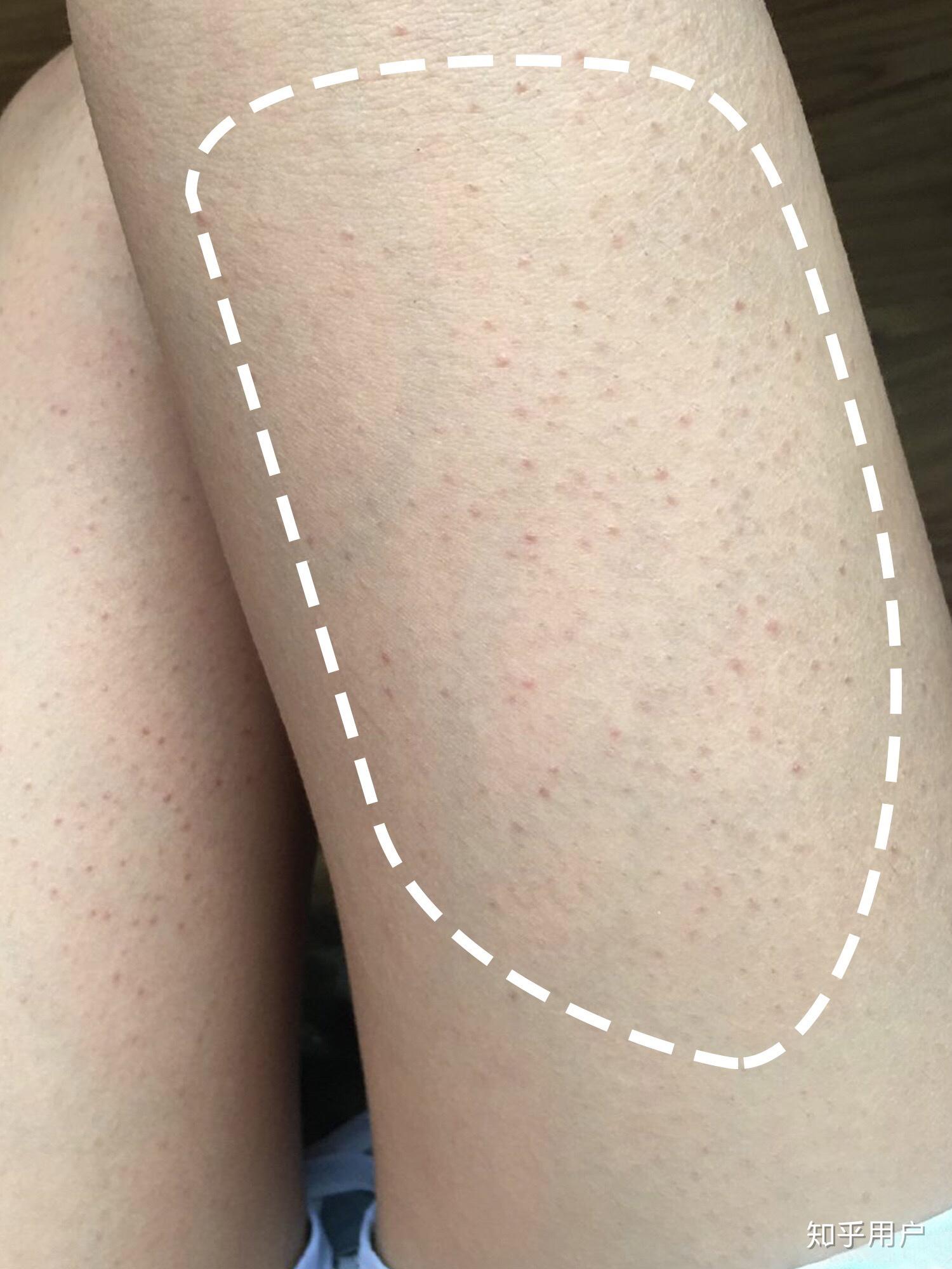 毛囊角质化(鸡皮肤)是否无法改善? - 知乎