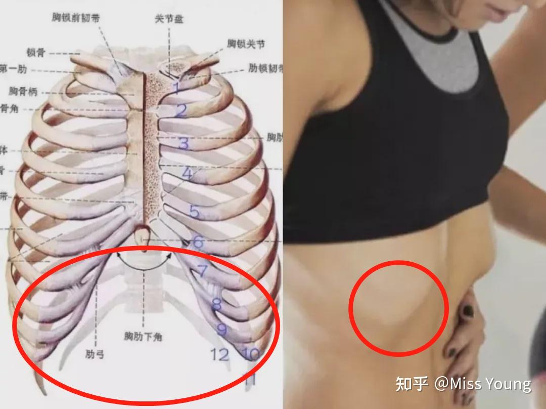 这是肋骨外翻吗