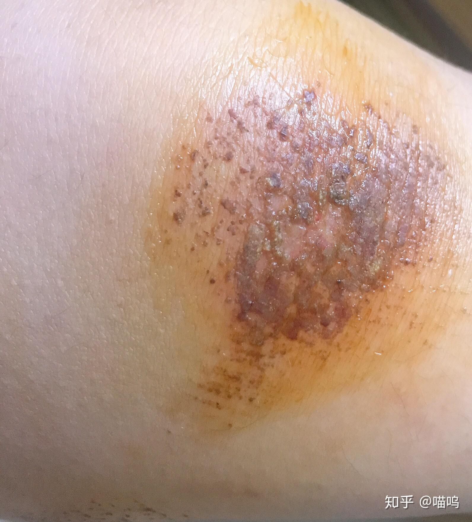 膝盖摔伤,抹了碘伏结痂后如何防止留疤?