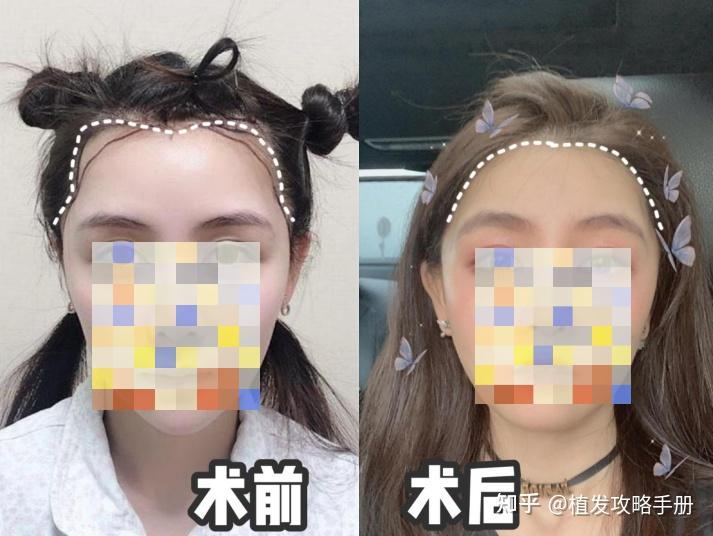 植发推荐么(植发是最好的选择吗?)