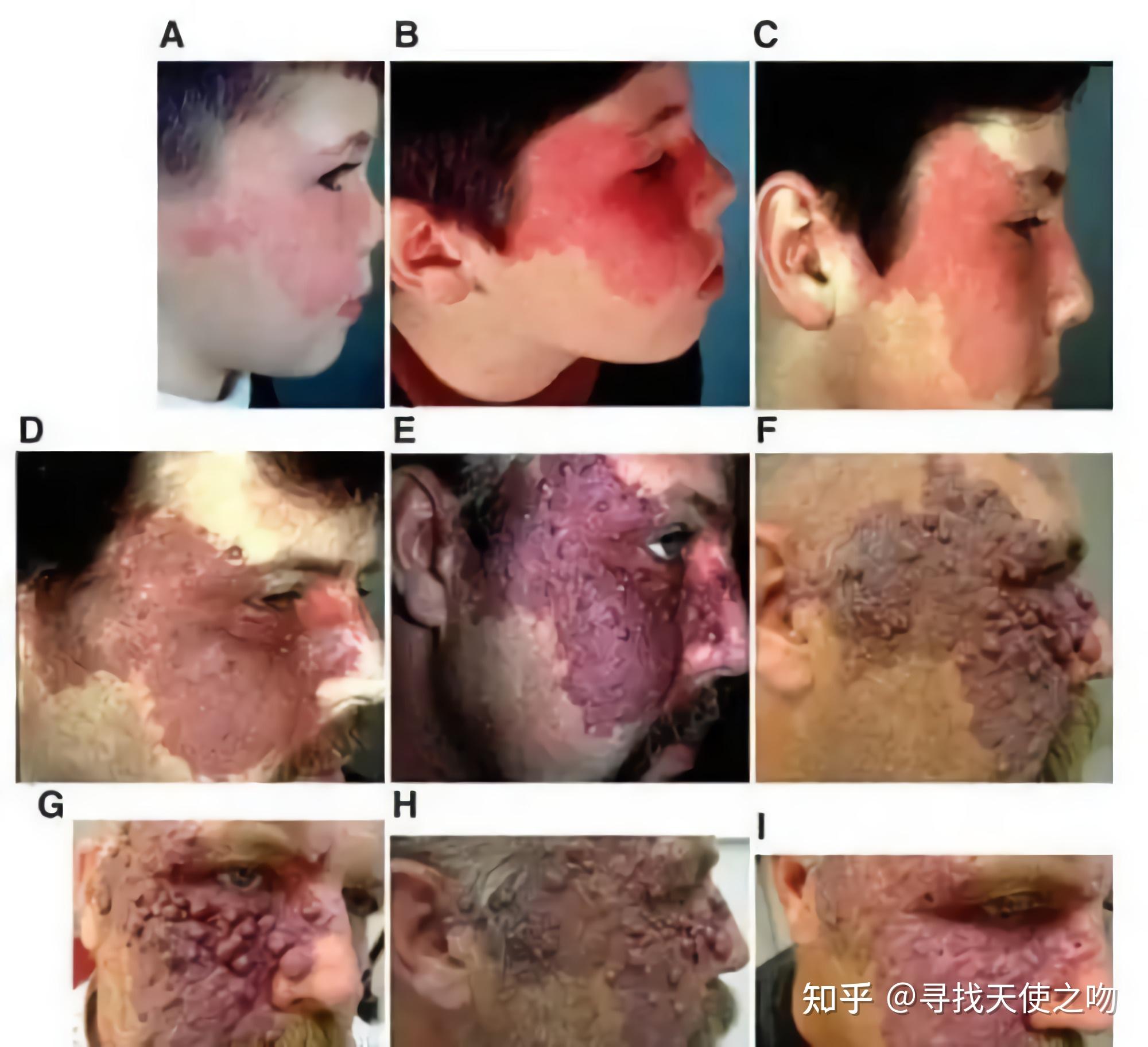刚出生宝宝身上的红胎记是鲜红斑痣还是鲑鱼斑?有什么区别吗?