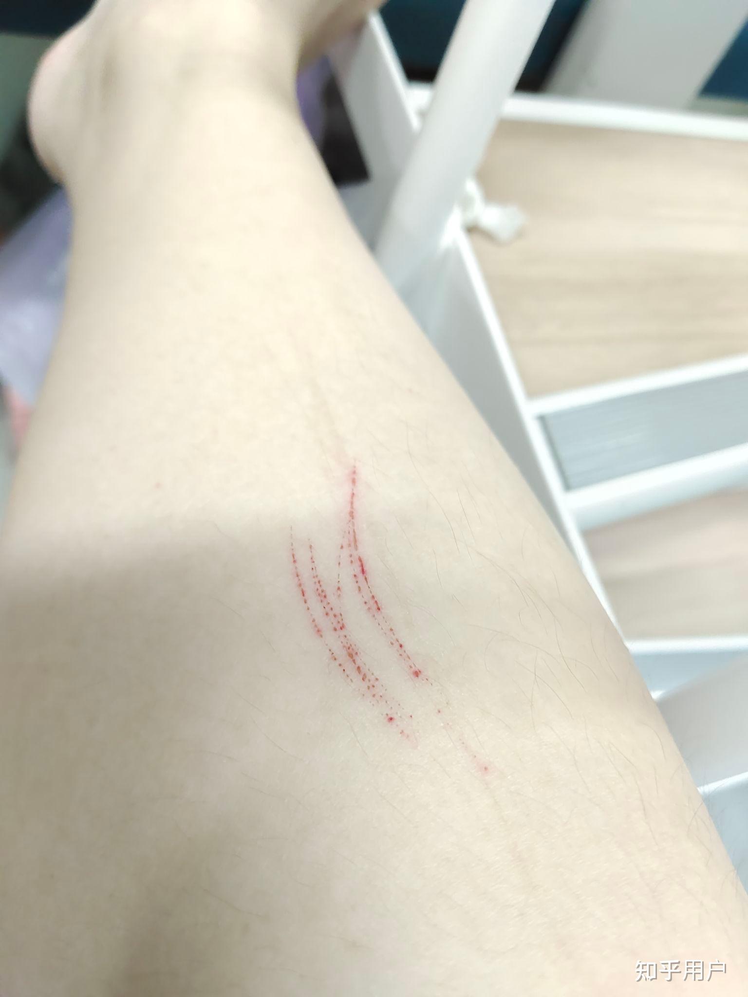 手臂突然出现一条很长的划痕是为什么?