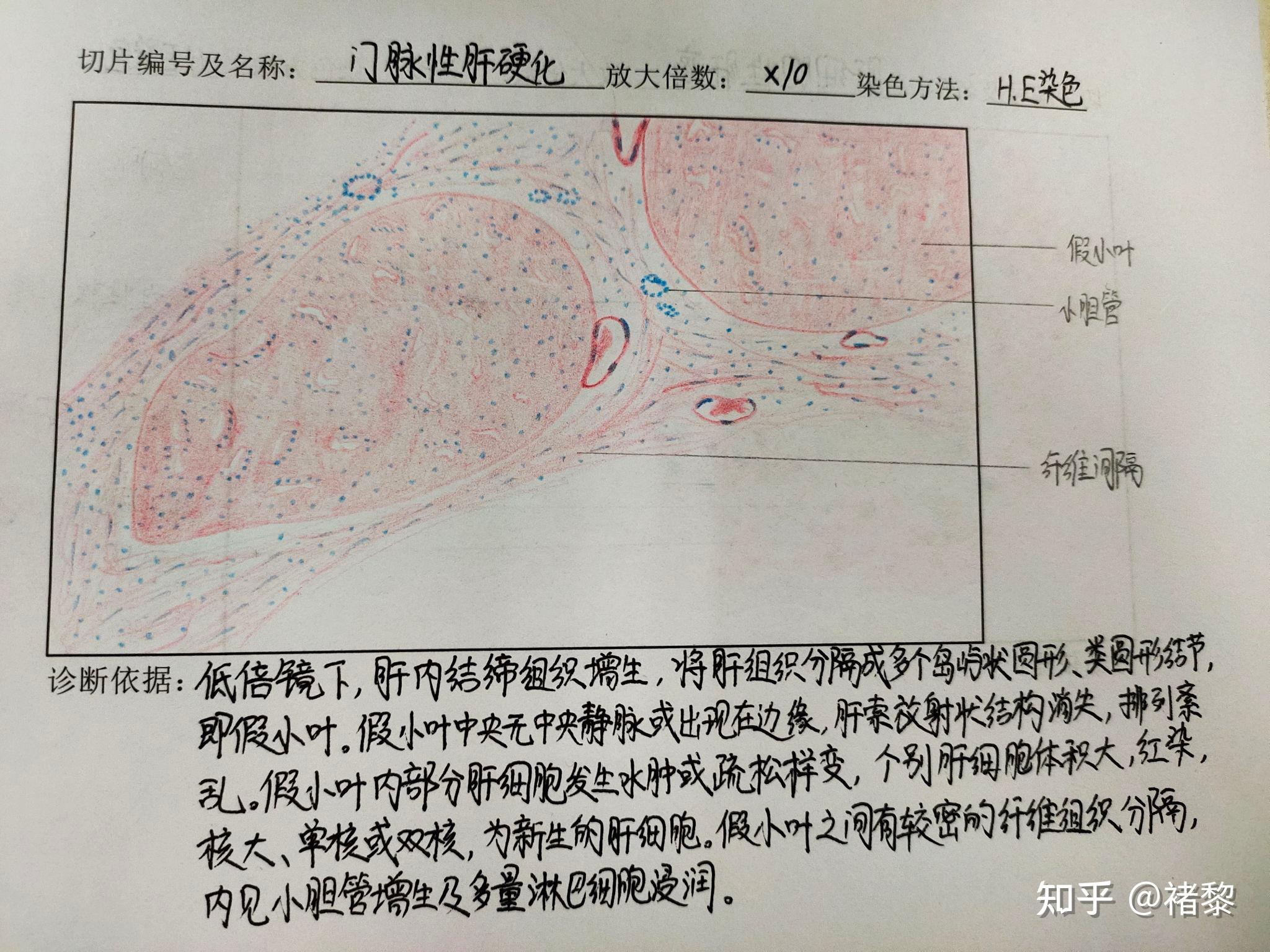 肠腺癌绘图图片