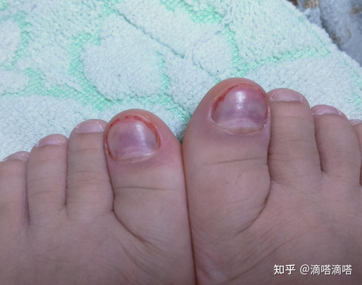 脚趾甲淤青怎么办? - 知乎