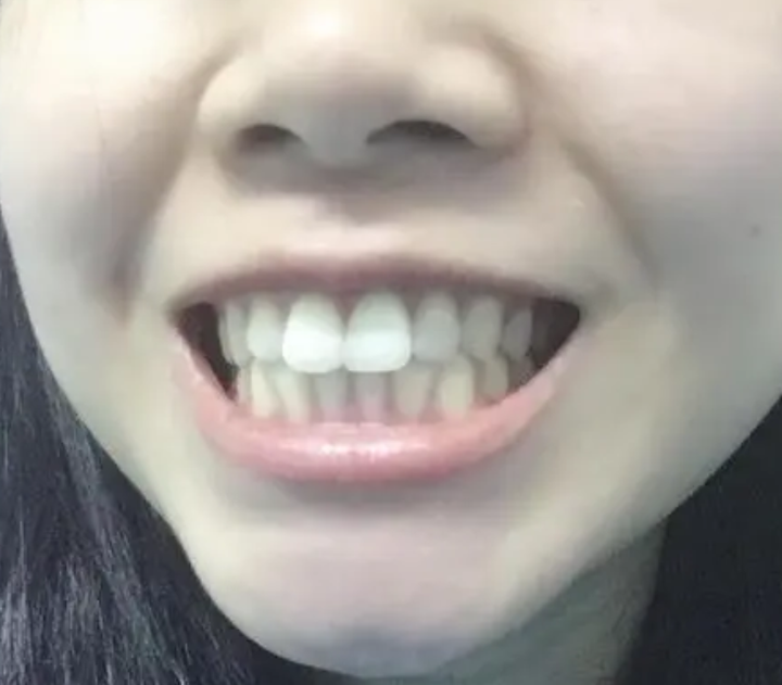 补牙后还能做牙齿矫正吗？尤其是门牙那块？ - 知乎