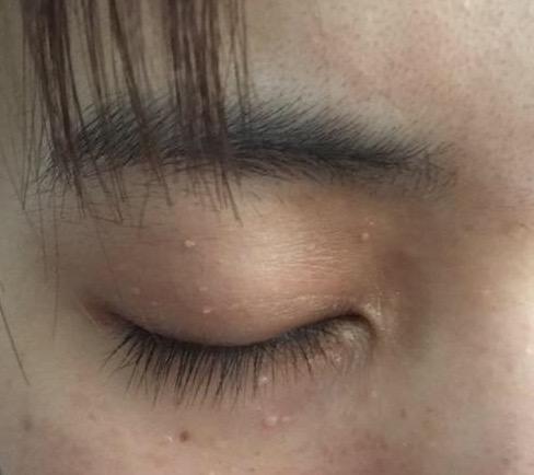 眼睛下面的汗管瘤有什么好办法消除能擦眼霜吗