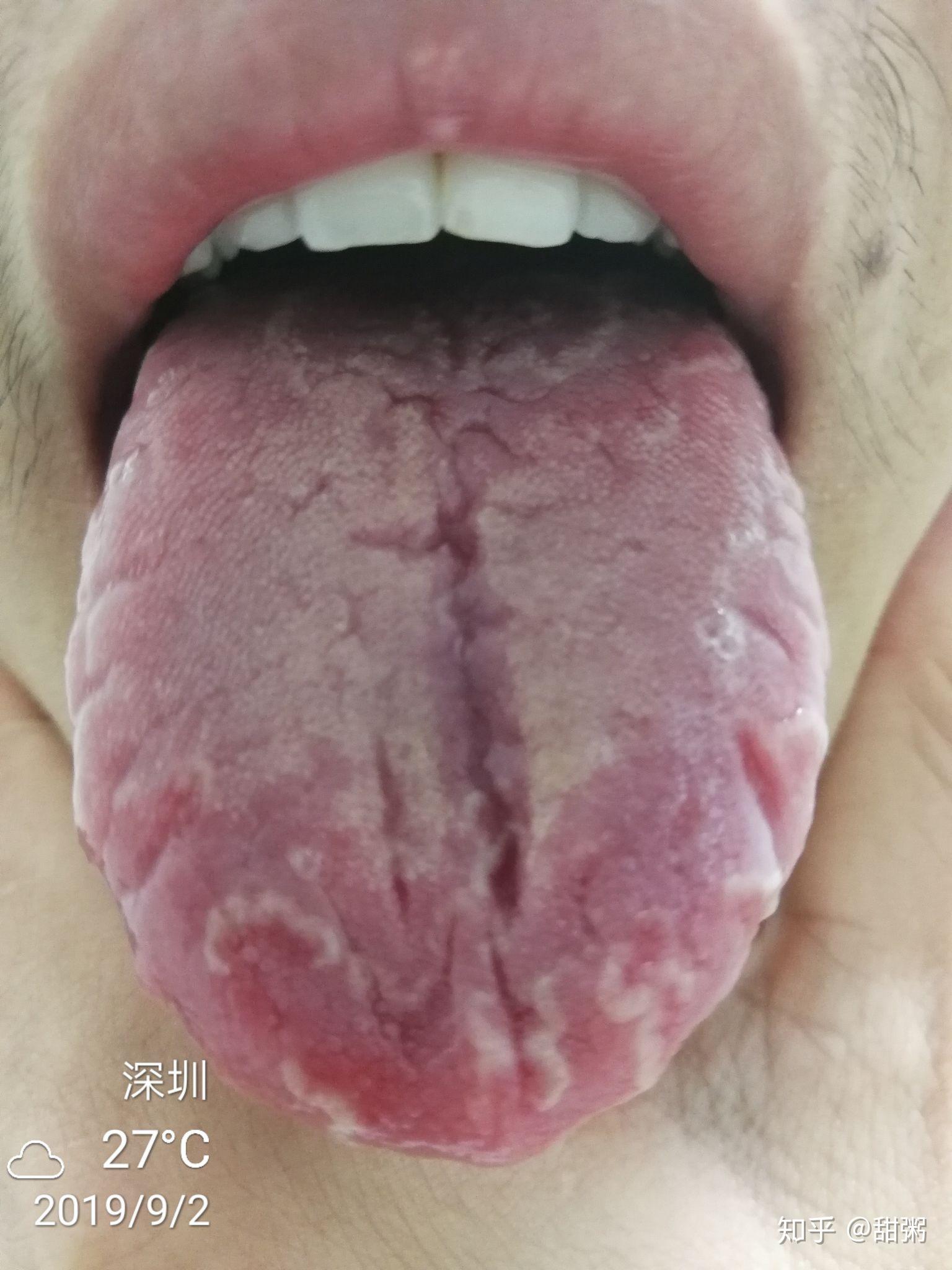 想请教这能估算出是哪种原因导致的裂纹舌吗