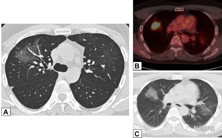 图片[7]-CHEST综述：机化性肺炎的诊断流程（临床-影像-病理特征相关性） | 每周呼吸-每周呼吸