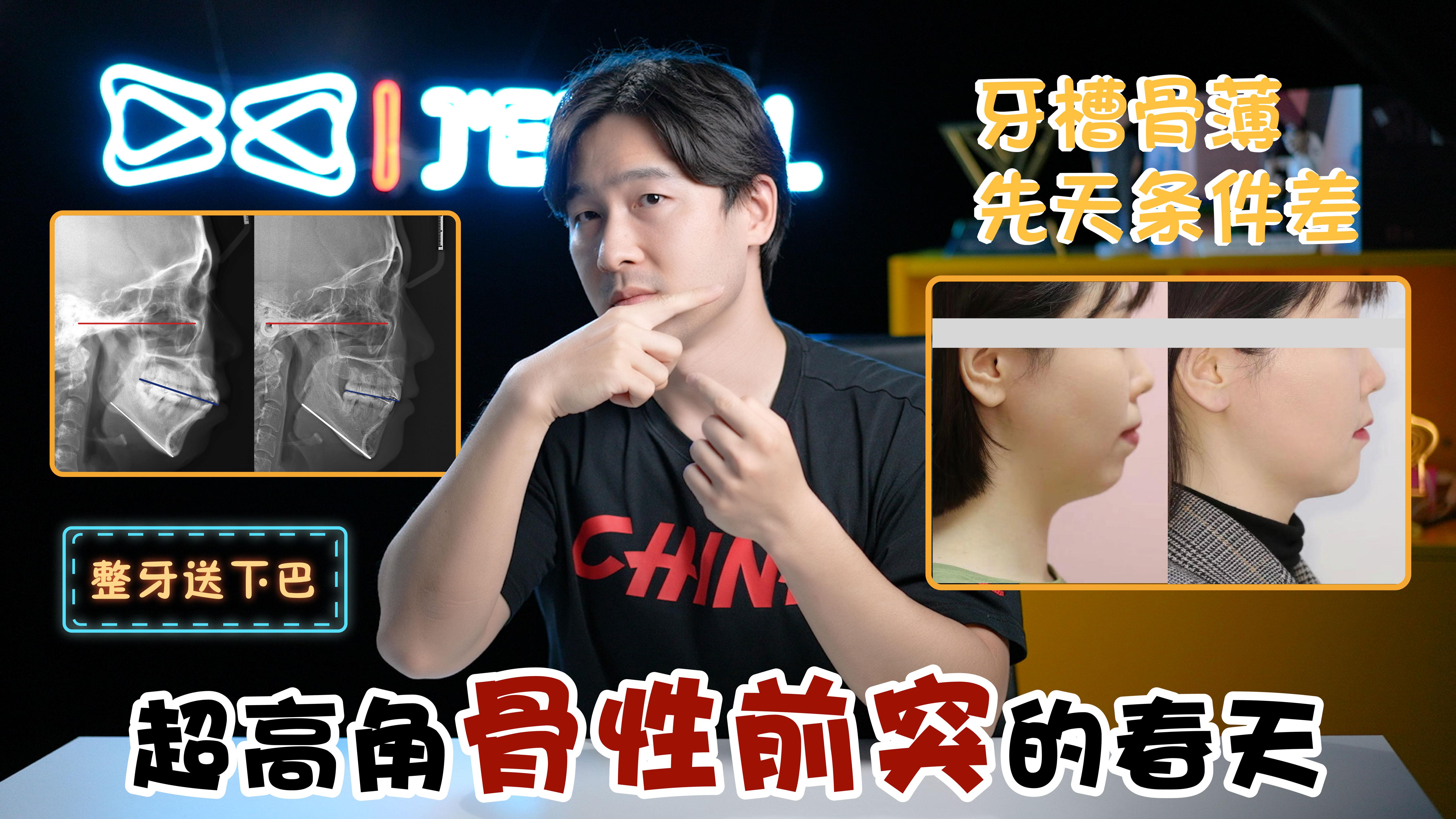 下颌逆旋再升级严重骨突超高角下颌后缩8颗骨钉恢复面型