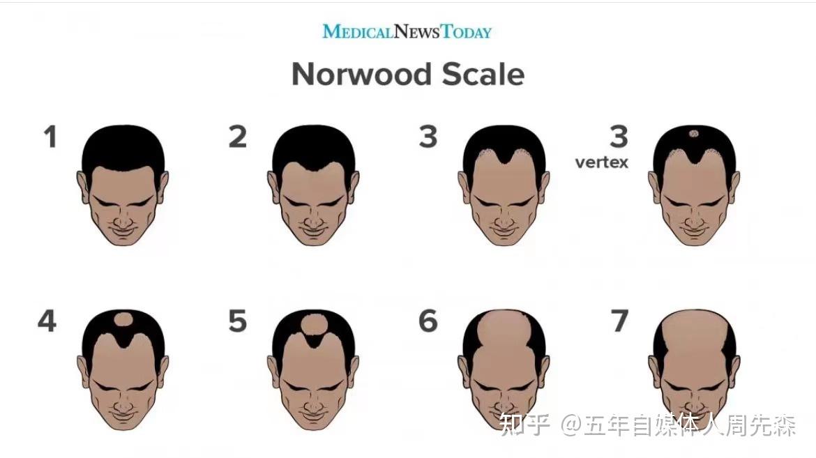 发旋处头发太少了！！！，我是不是要秃了，怎么办啊！？ - 知乎