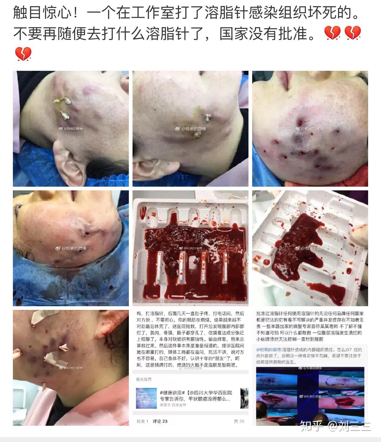 最近很火的6d小脸针是什么? - 知乎