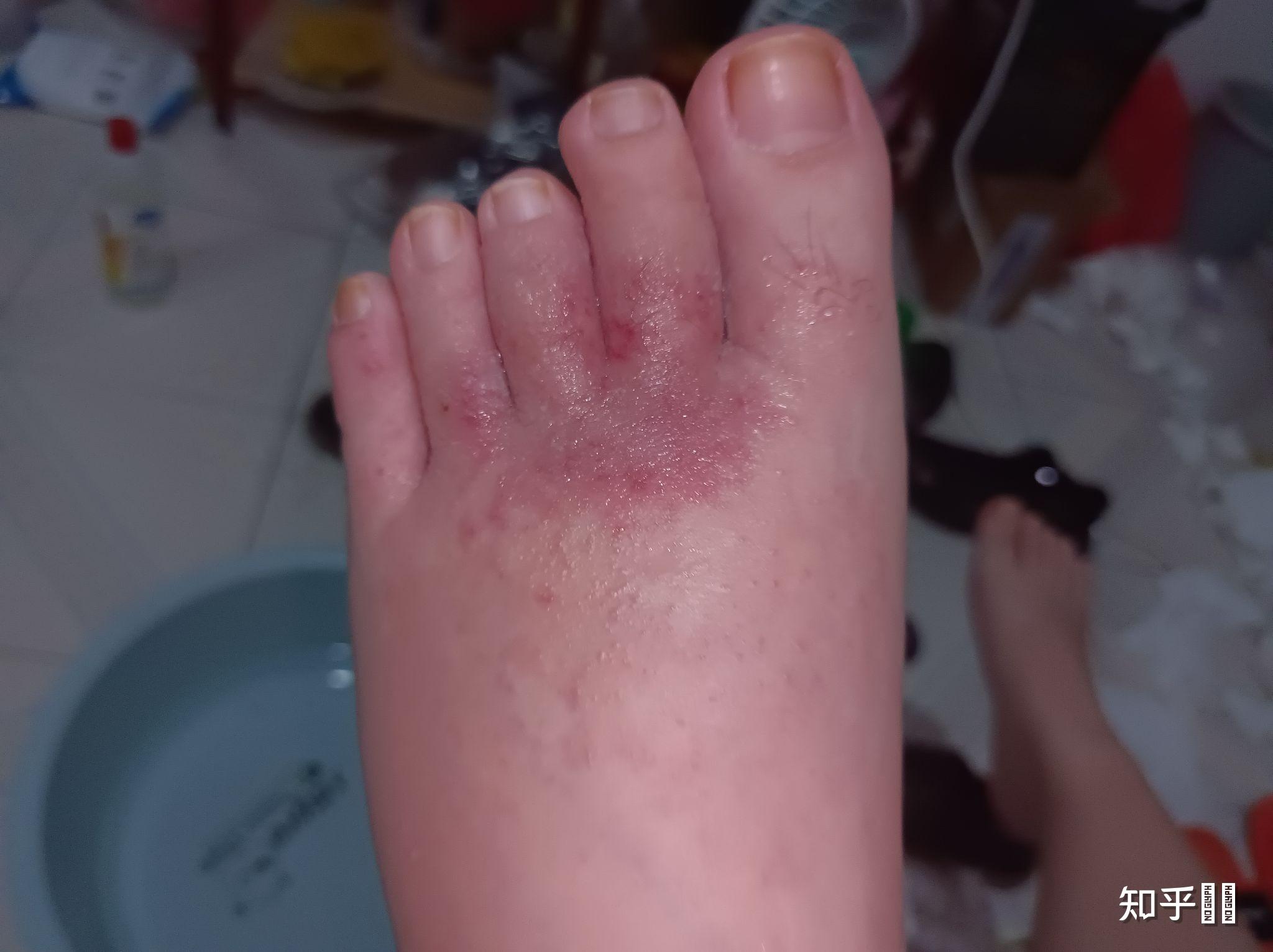 为什么有些人的脚气只长在一只脚上