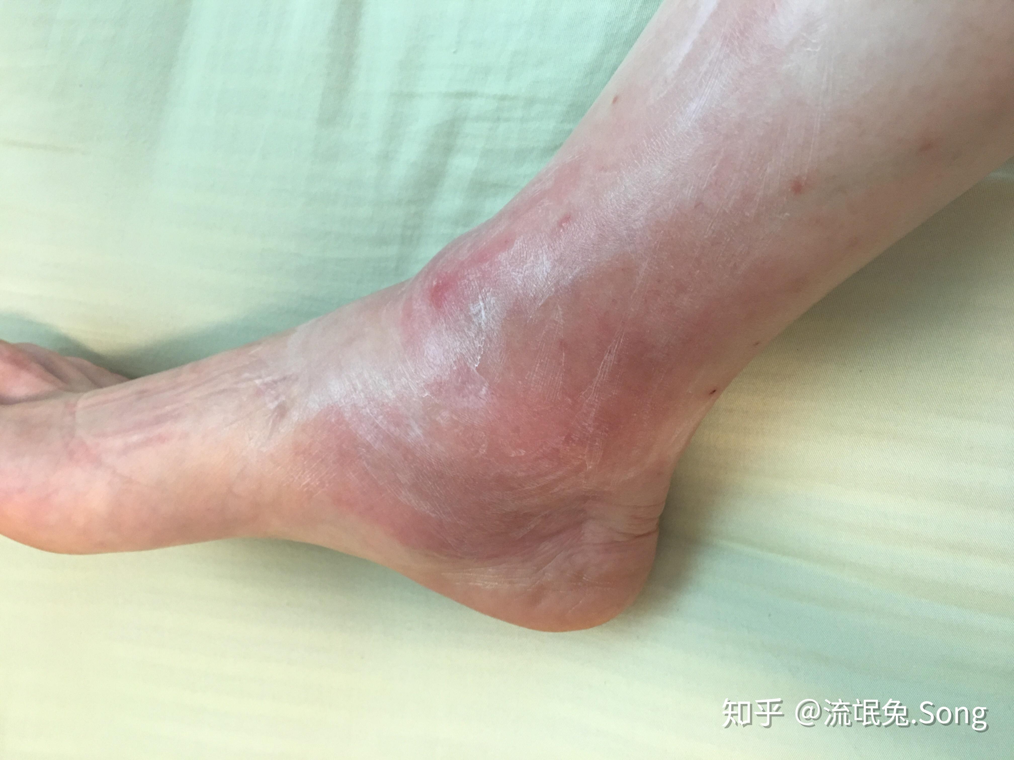 被蚂蚁咬怎么处理? - 知乎