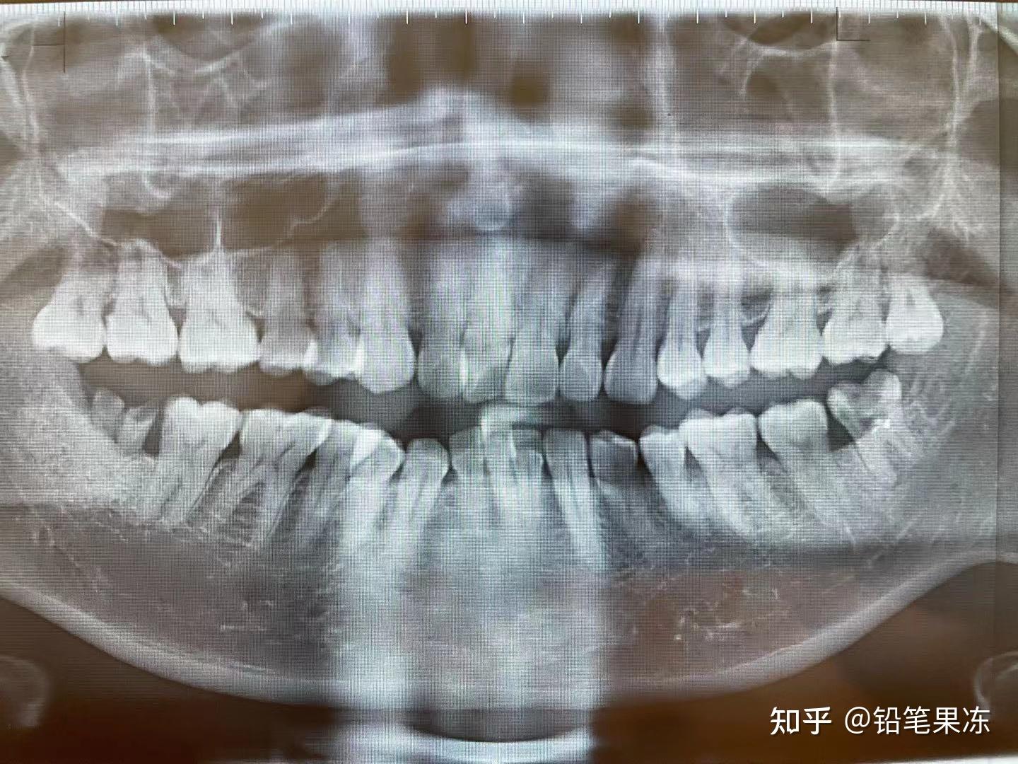 拔完智齒後右下第二磨牙有鄰面齲齒怎麼辦