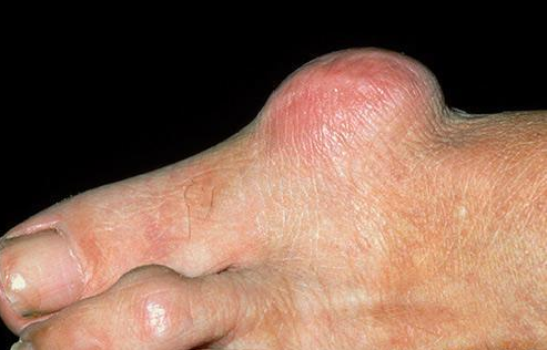 拇囊炎该如何治疗才有效?