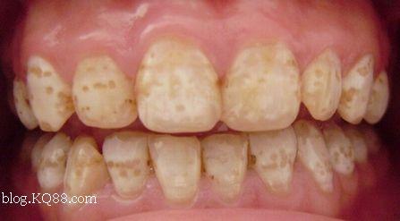 牙斑和蛀牙的区别