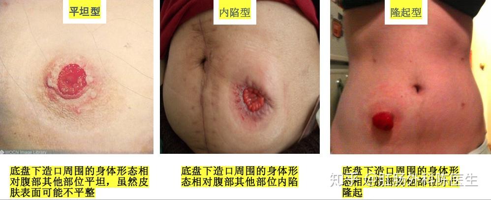 为什么说造口形态变化是造口渗漏的重要原因