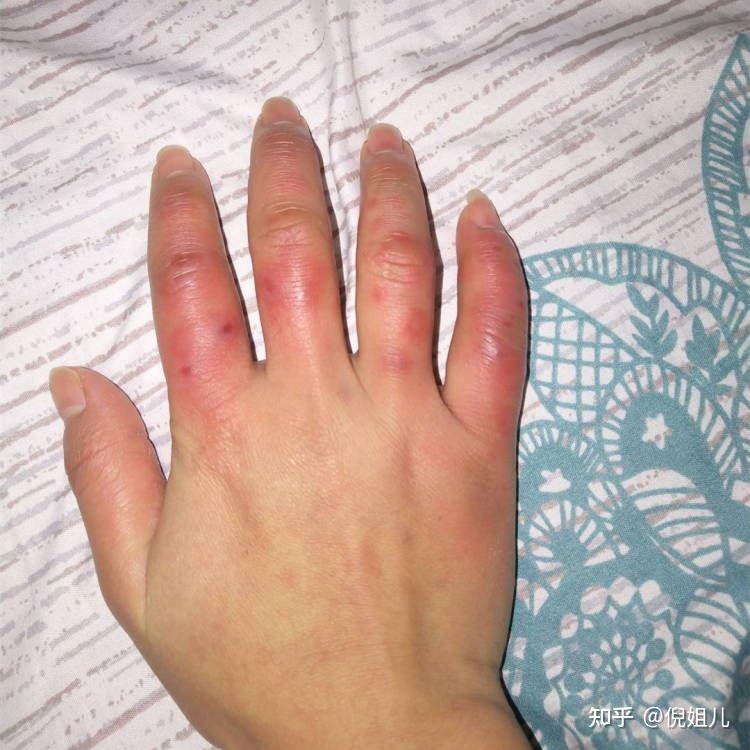 为什么每个冬天都会手都会冻伤.有没有什么方法预防和治疗呢?感谢.