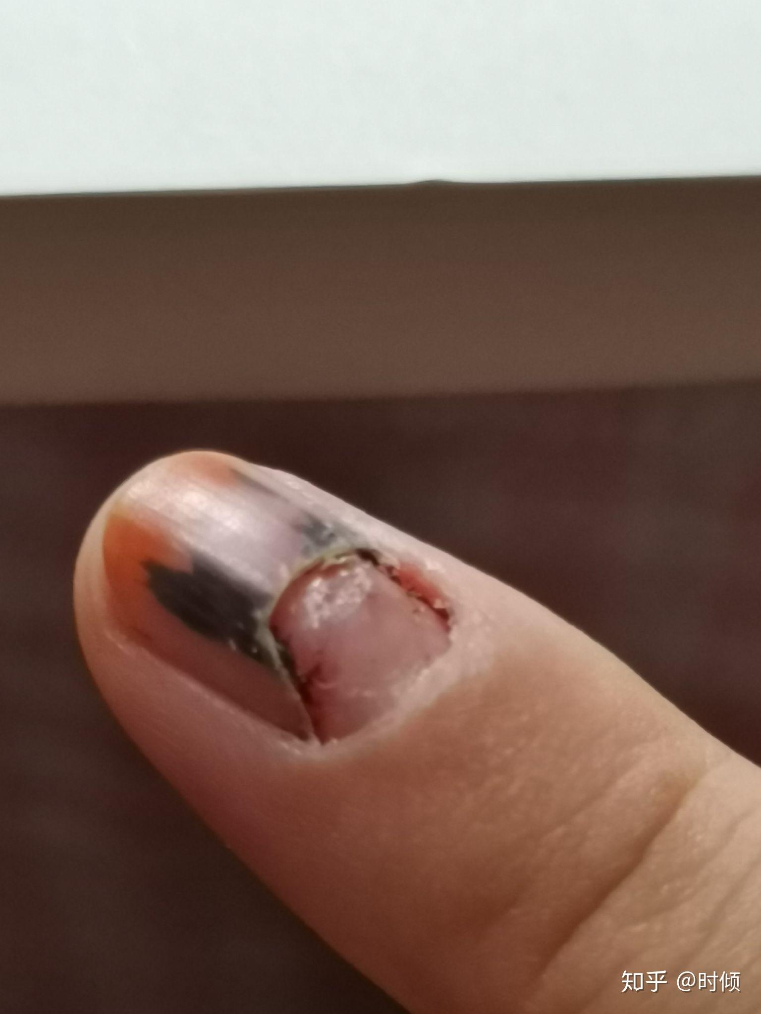 手指甲被夹到,过了一段时间,有黑色的淤血,怎么处理? - 知乎