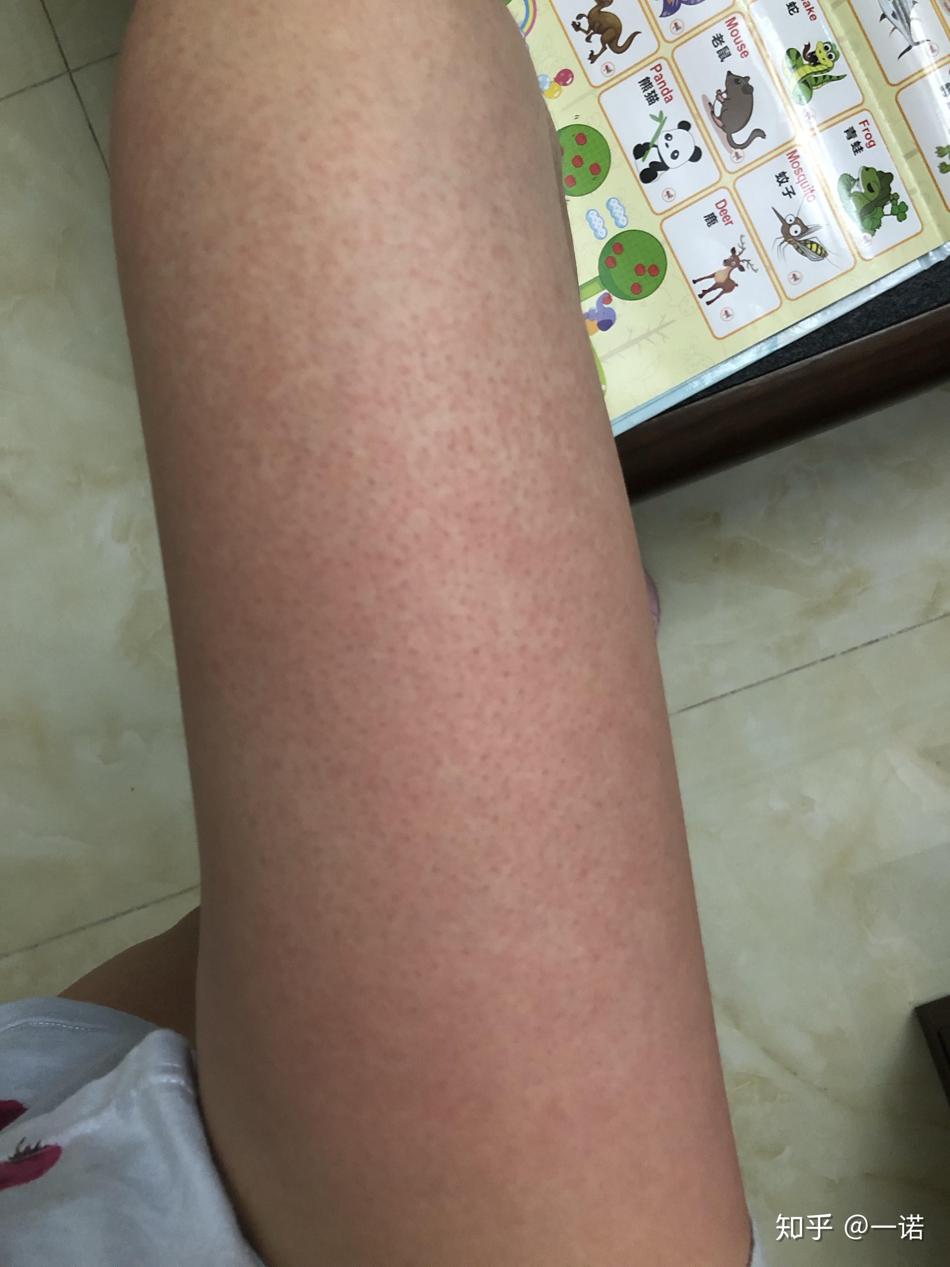 酒精过敏的人喝多了会怎么样? - 知乎