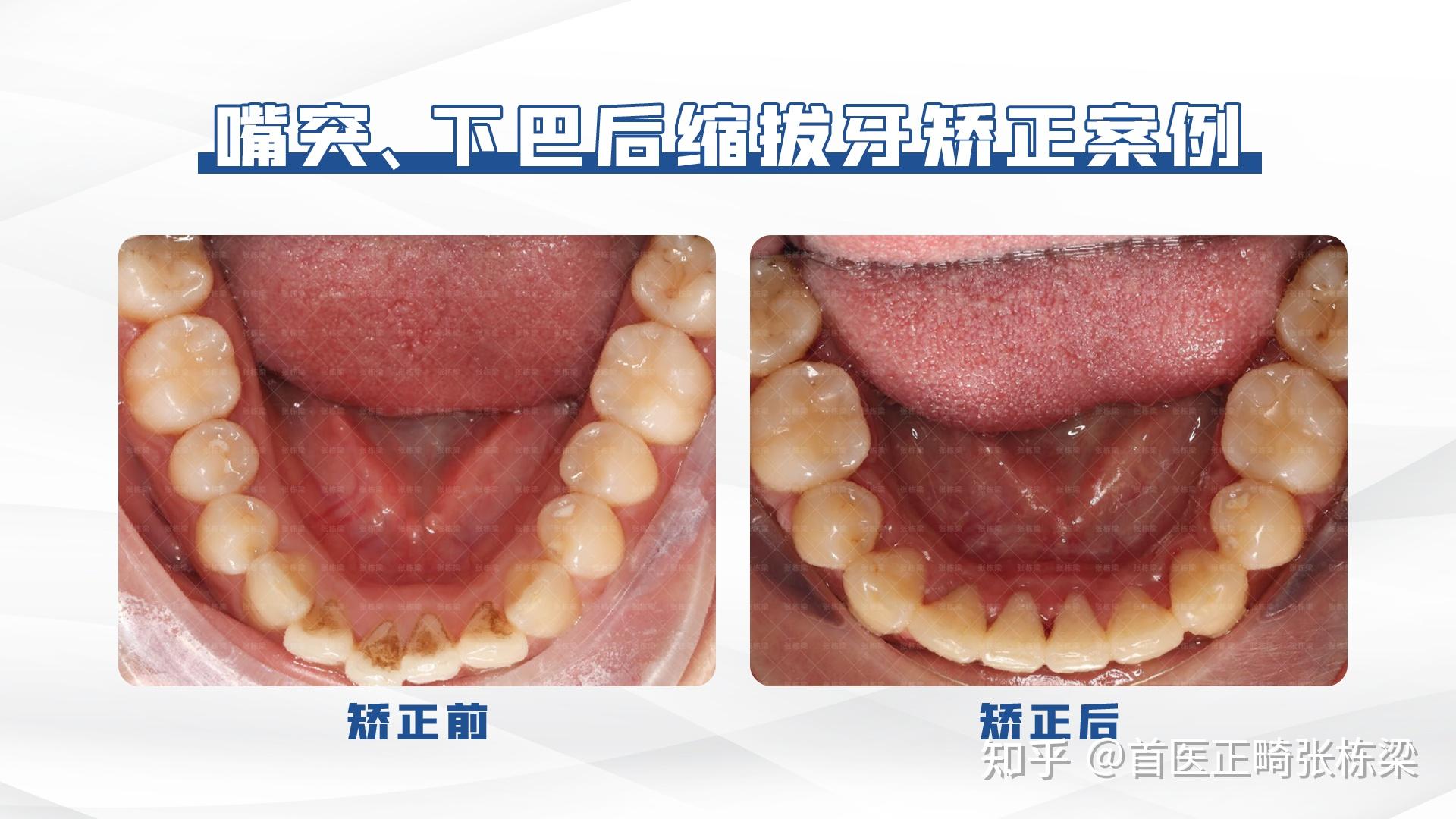 北京牙齿矫正 | 高难度骨性前突没下巴，舌侧牙齿矫正重获自信！
