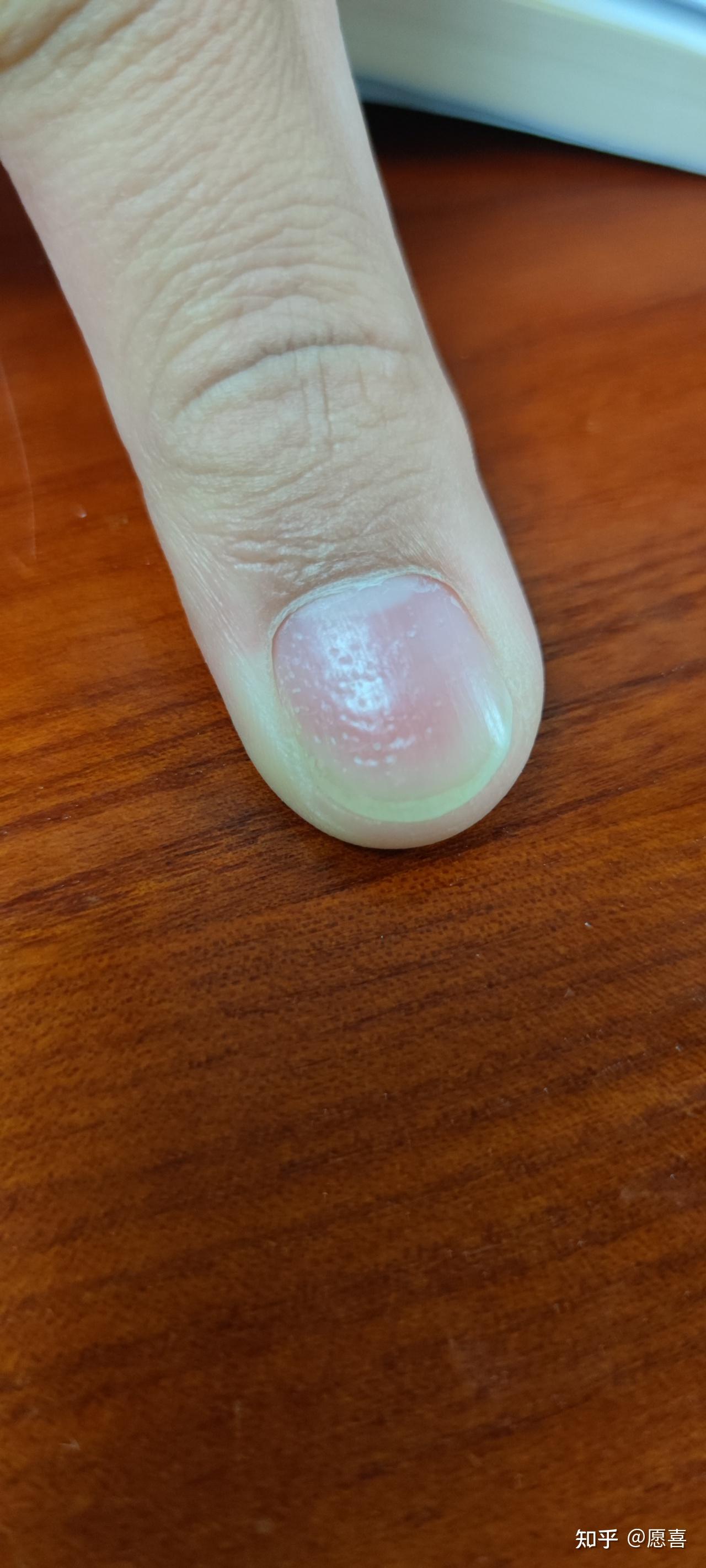 手指甲最近变得坑坑洼洼,还有长出白点,是什么原因啊?缺什么吗?