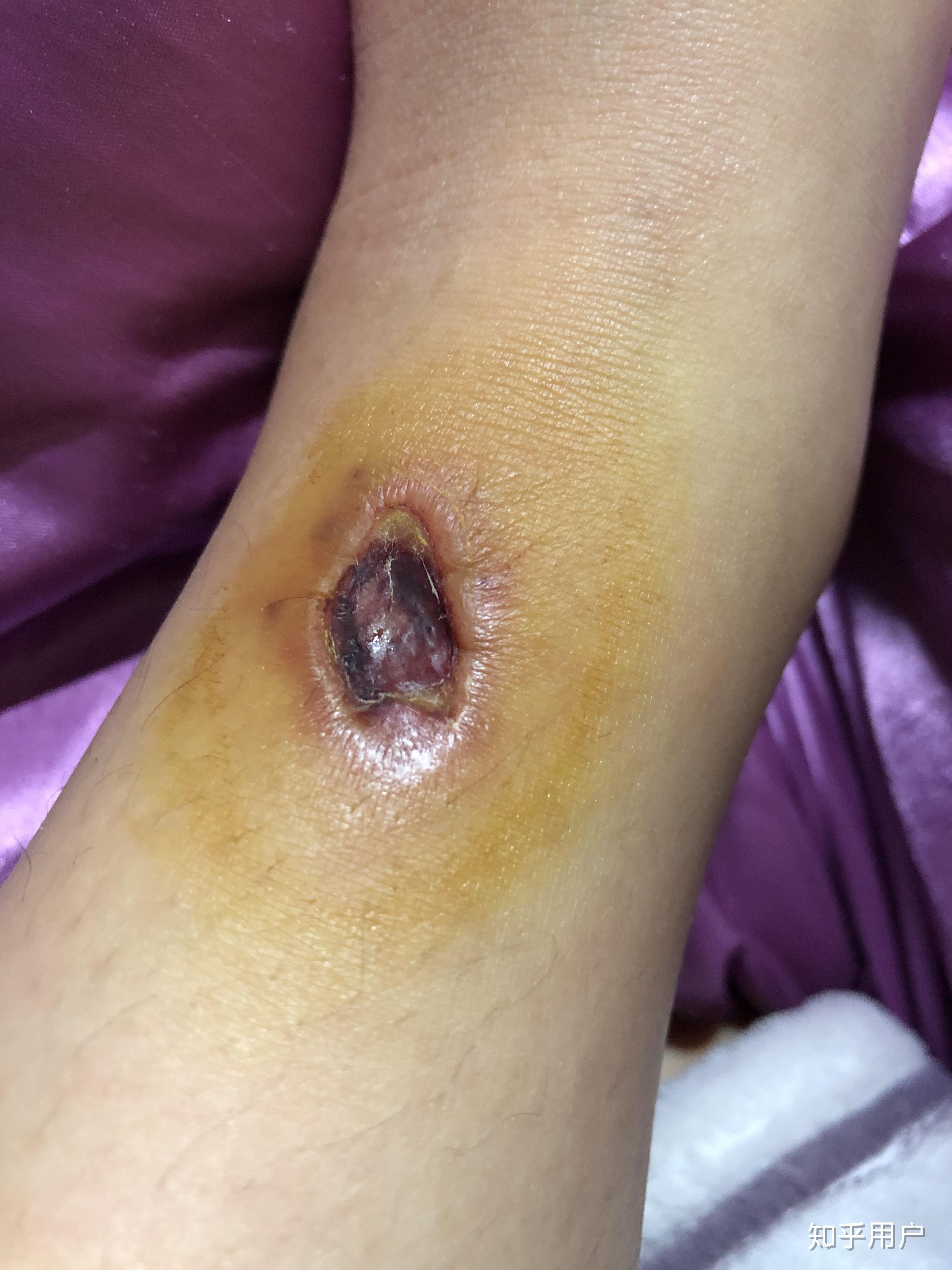 被毒蚊子咬了肿了很大一个包还很硬之后肿的包上面起了水泡挑破之后第